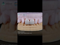 Natürliche Pressen EMAX Veneer Festigkeit 16 Farbtöne Emax Zahn Veneers