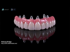 Hybride rosa Porzellan Implantat Krone Malong Vollbogen Implantat Brücke Sofortiges Laden
