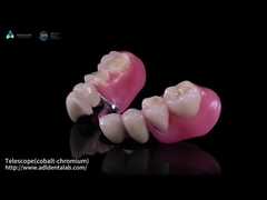 Teleskop Innen-Co-Cr und Außen-Co-Cr Metall teilweise mit Verbundwerkstoff