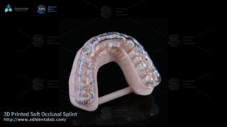 Individuelle 3D-gedruckte Schiene für Bruxismus-Komfort