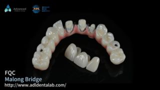Hybridimplantat Malo Bridge Secure Smile