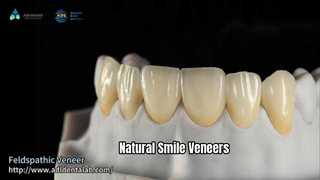 Natural Smile Veneers Hochtransluzente Feldspatkeramik
