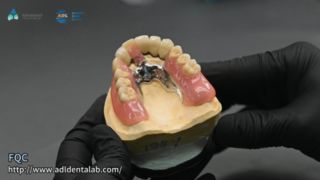 Teleskopkrone. Präzisionslötqualität