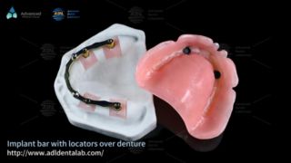 Premium Implant Bar and Locator Attachment Solution