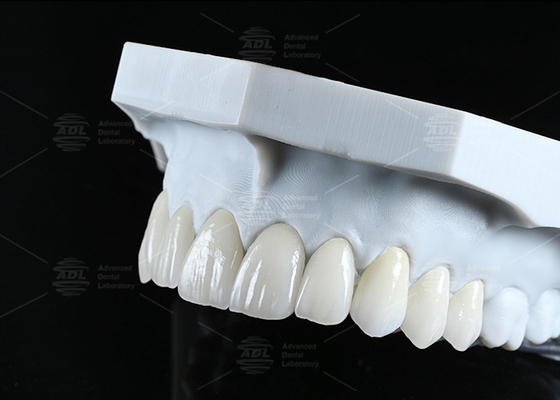 kaufen Transluzente CAD EMAX Veneer Polierte Verglaserte Keramik Restaurationen für vordere hintere Bereiche Online-Herstellung