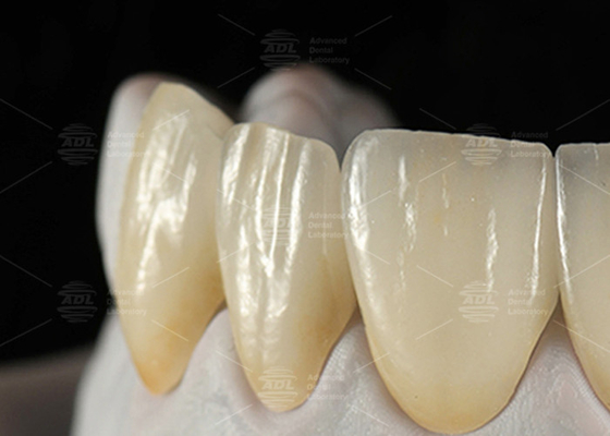 kaufen 0.3mm-0.7mm Feldspatische EMAX Keramik Veneers Natürliche ästhetische Emax Zahn Veneers Online-Herstellung