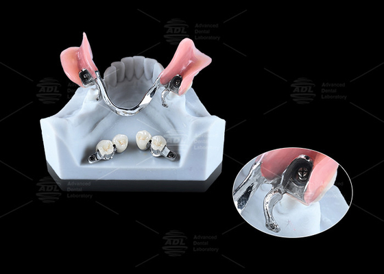 kaufen 0.1 mm Toleranz CEKA REVAX Anschluss Titan 3 mm vertikale Freiheit Online-Herstellung