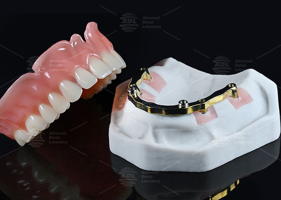 kaufen China Dental Lab Titanium Locator Anschluss mit Vollakryl über den Zahnersatz Online-Herstellung