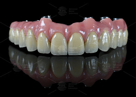 kaufen China Dental Lab Hybrid Bridge Implantat Bar Malong Design Schraube behalten oder Zement Installationsmethode für Präzisions-Zahnanwendungen Online-Herstellung