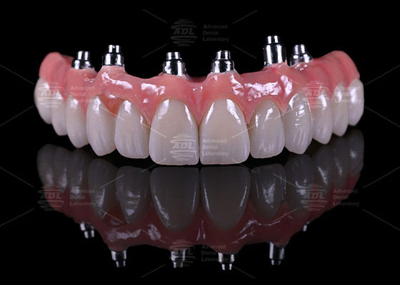kaufen China Dental Labor Titan-Schrauben-Retained Malong-Design A1 Farbton Vollbogen Hybridbrücke Online-Herstellung