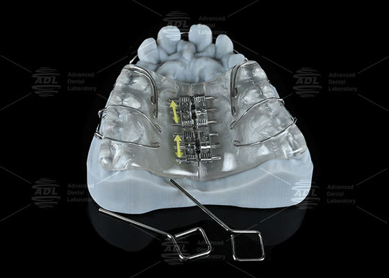 kaufen China Dental Laboratorium Buntes Edelstahl-Schraubenexpander für Ober- und Unterkiefererweiterung Online-Herstellung