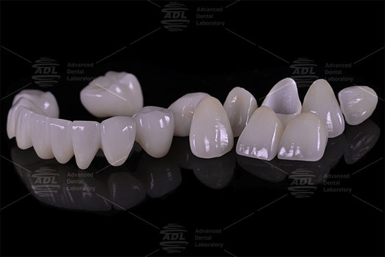 kaufen China Dental Lab Porzellan mit Zirkonie hochfester Zirkonium-Verbindung bietet maßgeschneiderte Dienstleistungen für internationale Zahnärzte und Zahnärzte Online-Herstellung