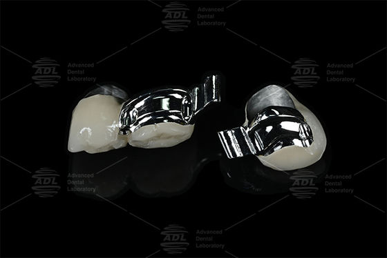 China Dental Lab Einstellbarer Patienten-spezifischer Schlüsselweg Präzisionsanschluss mit PFM