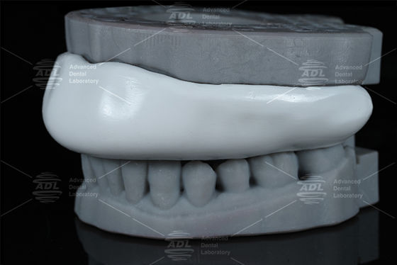 Bequeme Occlusal Splint Sport Guard Biss Splint Design leicht zu reinigen Komfortable Schutzvorrichtung zum Zahnschleifen