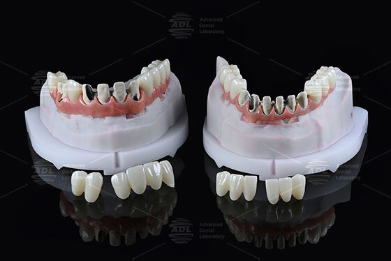 Chinesisches Dental-Labor Titan-Vollbogen-Hybridbrücke mit Sofortbelastung, Farbton A1, Malong-Design, schraubenfixiert, CAD/CAM