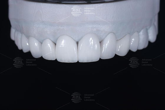 China Dental Lab High Esthetics Translucency EMAX Veneer with 0.3-0.5mm Thickness for Anterior and Posterior Restorations